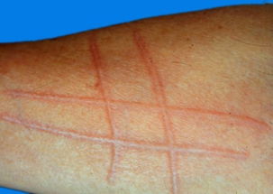 得了荨麻疹怎么办 原创