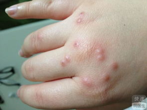 小儿荨麻疹能洗澡吗 荨麻疹的这些常识你要懂