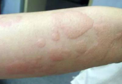 面对 来去如风 的荨麻疹,如何有效应对