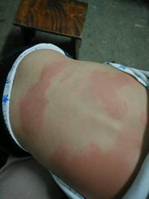 荨麻疹_我家宝宝起了荨麻疹,去医院治老反反复复,哪位宝妈有偏_宝宝树