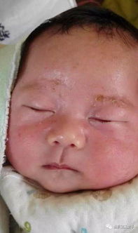 湿疹与荨麻疹的病因病机及名医名方调理案例分析