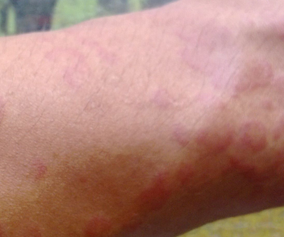 荨麻疹 症状、诱因与治疗方法详解