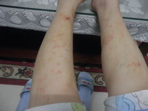 湿疹反复发作？一敷一喝，简单应对湿疹与荨麻疹