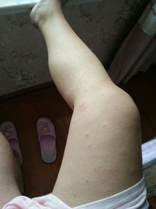 孕妇得荨麻疹的应对与注意事项——以2018年10月宝宝圈为例