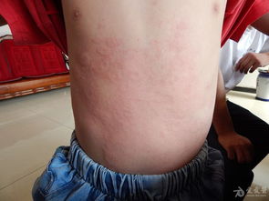 荨麻疹 症状、原因与防治措施