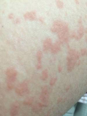 荨麻疹突发？胳膊腿长满疙瘩痒得不行，教你快速应对