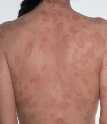 荨麻疹的症状及图片识别指南