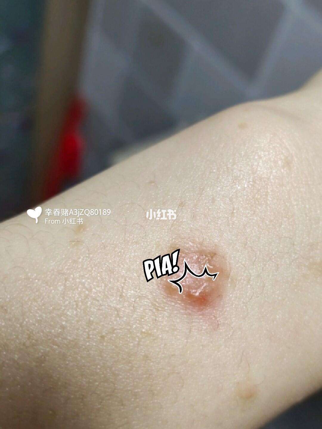 荨麻疹与湿疹的区别 如何分辨并正确处理