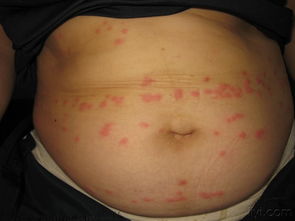 丘疹性荨麻疹与荨麻疹 看图诊断与鉴别要点