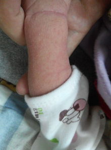 新生儿皮肤问题辨别 痱子、湿疹与荨麻疹的特征区分