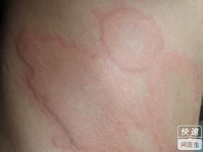 荨麻疹症状图片展示 从图片认识不同类型的荨麻疹