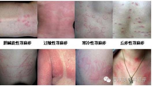 通过哪些检查项目确诊荨麻疹