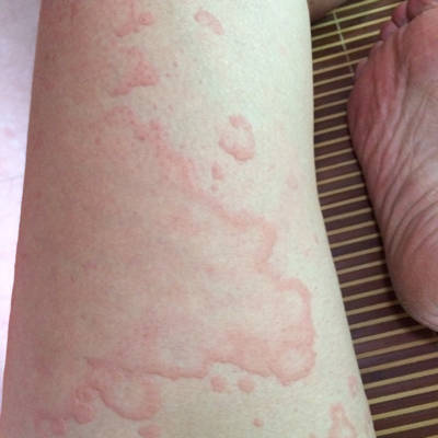 一身长这样子的荨麻疹能喂奶吗?请看图,或者有没有更好的办法能冶疗我的荨麻疹?特难受,全身都有,包括脸。求解?