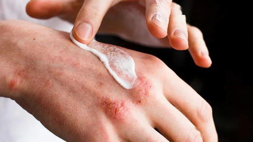 汗疱疹 一种特殊类型的湿疹，与荨麻疹的病因探析