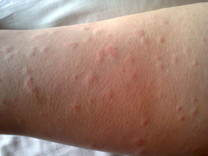 产后荨麻疹 症状解读与识别指南