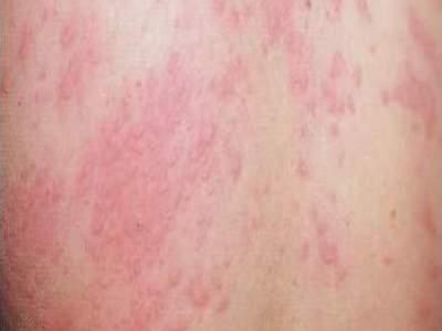 探寻荨麻疹的自然疗法 一株植物的传说与现实