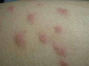 荨麻疹会遗传吗？探寻遗传因素与发病可能