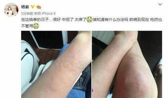 杨紫腿部红肿引担忧，疑似荨麻疹惹心疼，健康提醒引热议