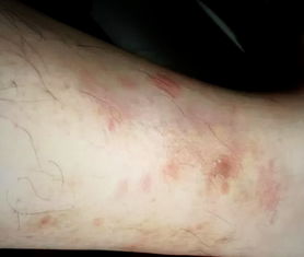 “又痒又热”，警惕这几种“披着荨麻疹外衣”的皮肤问题