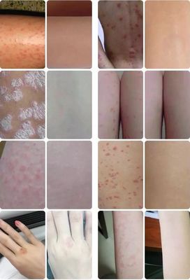皮肤奇痒难耐，你还在抓吗？告别荨麻疹的三大科学法——如何轻松KO皮肤顽疾