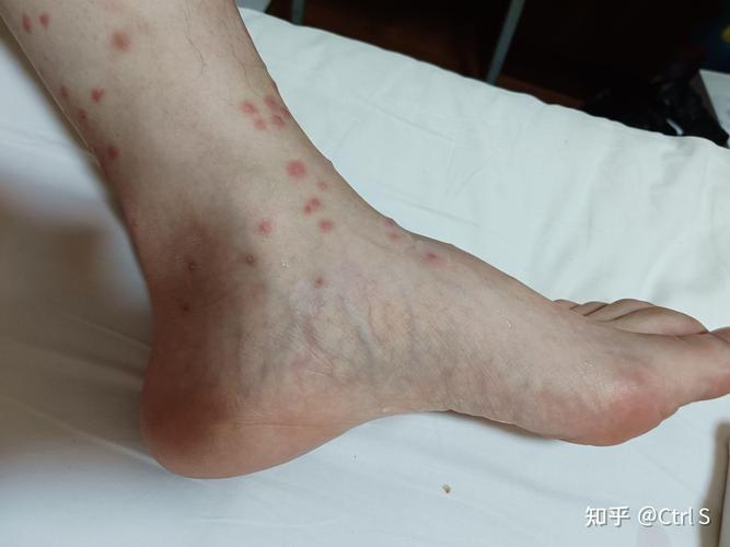 我的皮肤抗争记 从汗疱疹、脂溢性皮炎到荨麻疹的治疗历程