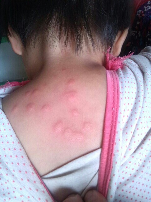 宝宝患了荨麻疹，家长如何应对与护理