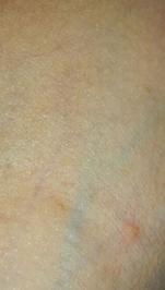 丘疹性荨麻疹与荨麻疹的鉴别 帮助您初步判断家人皮疹类型